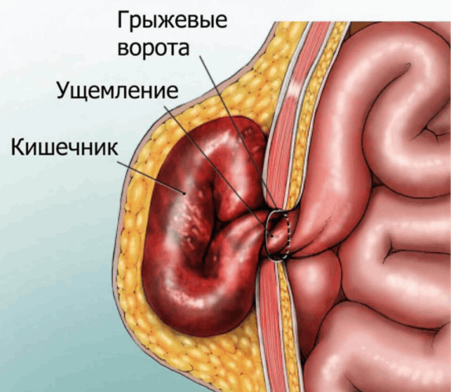 грыжи передней брюшной стенки 02