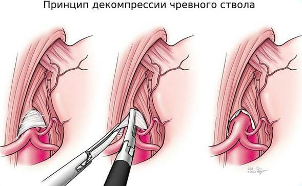 синдром-данбара-08