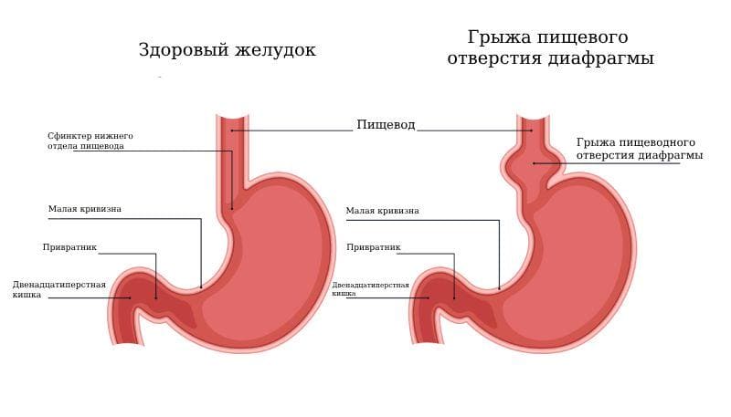 Рентгеновская-диагностика-и-классификация-грыж-пищеводного-отверстия-диафрагмы-01