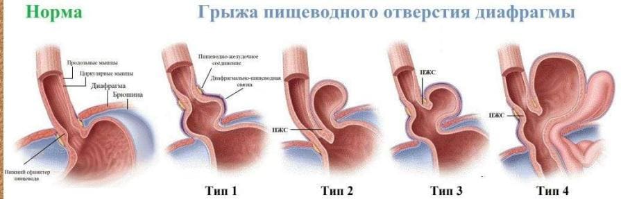 Рентгеновская-диагностика-и-классификация-грыж-пищеводного-отверстия-диафрагмы-03