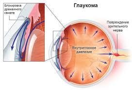 глаукома-ранняя-диагностика-01