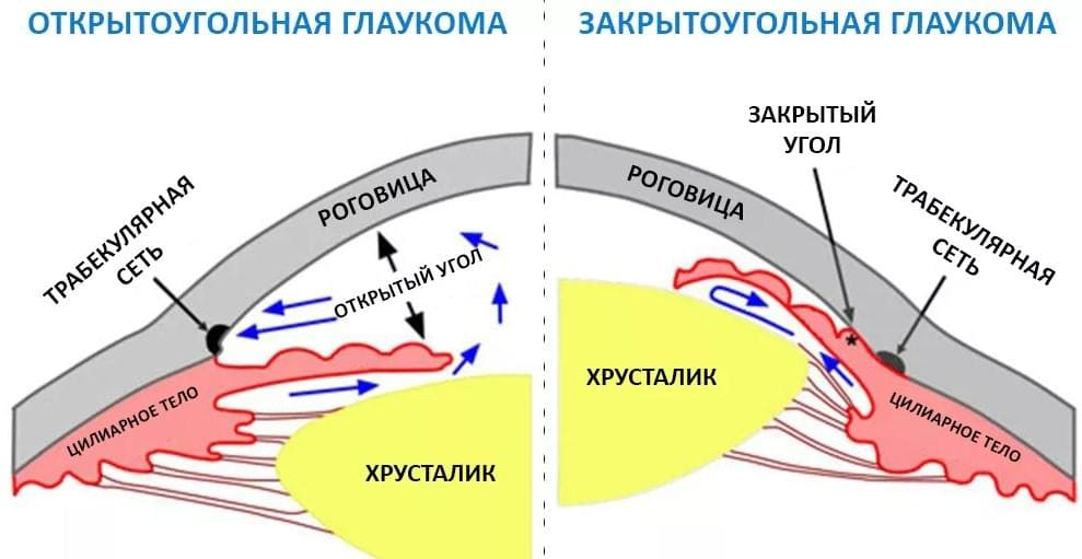 глаукома-ранняя-диагностика-02