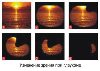 глаукома-ранняя-диагностика-05