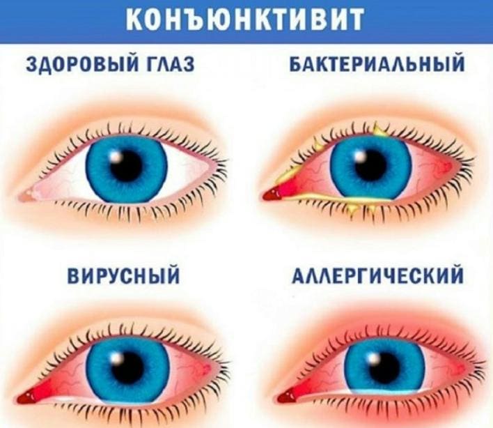 коньюктивит