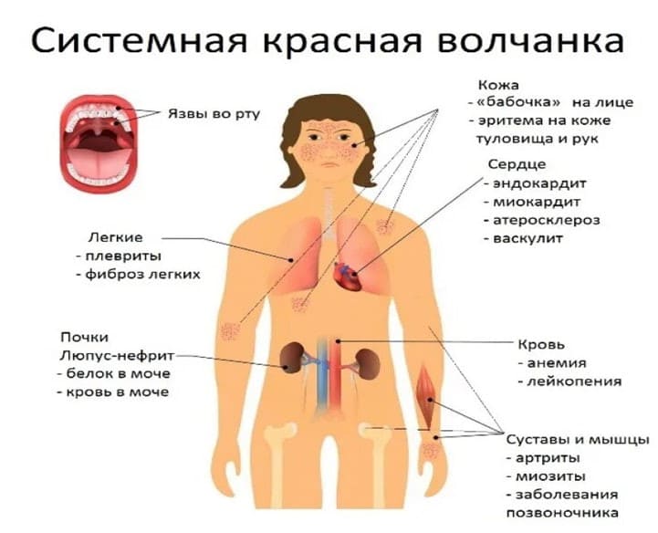SISTEMNAJa_KRASNAJa_VOLChANKA._OFTALMOLOGIChESKIE_PROJaVLENIJa__Porazhenie_perednego_segmenta_glaza