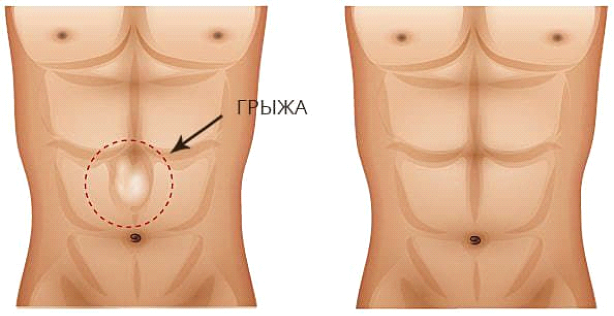 Грыжа белой линии живота: диагностика, симптомы, лечение, последствия и причины заболевания