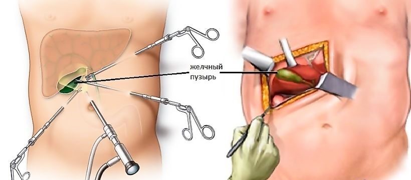 Камни в желчном пузыре и методы лечения | «Бест Клиник»
