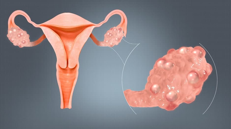 Киста яичника: как обнаружить и можно ли вылечить?