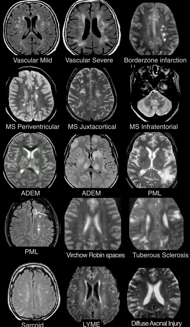 Дифференциальная диагностика поражений белого вещества головного мозга при  магнитно-резонансной томографии