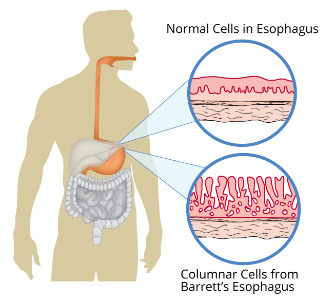 пищевод баретта 1