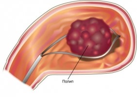 полипы желудка 03